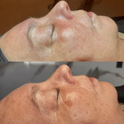 Voor en na een huidbehandeling: egalere, stralendere huid bij Pure Body Bliss